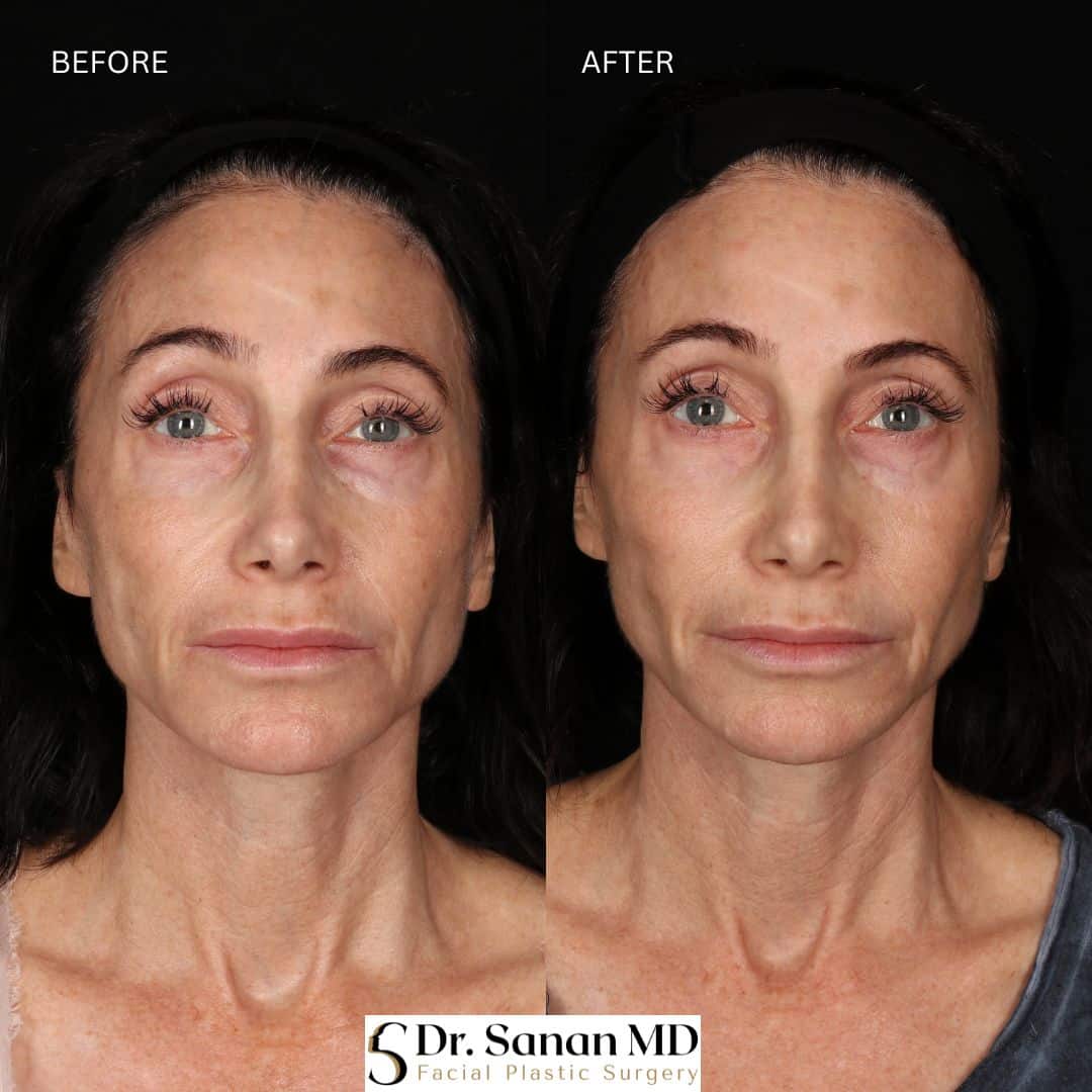 Akshay Sanan MD Facial Plastic Surgery